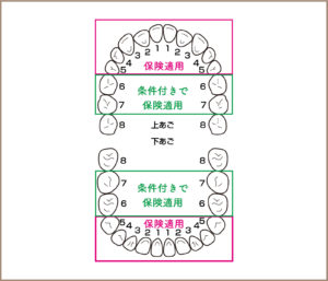 福山　保険適用　白い歯